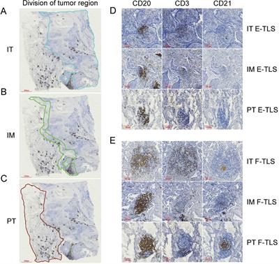 Density of tertiary lymphoid structures and their correlation with prognosis in non-small cell lung cancer